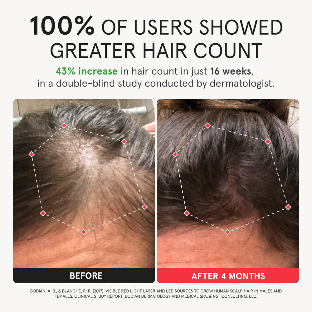 iRestore Elite scalp coverage highlighting hairline, temples, and crown areas